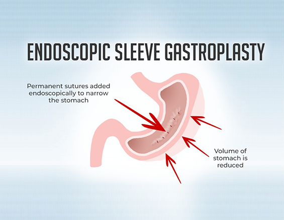 best bariatric surgery