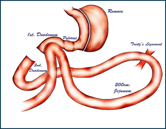 best bariatric surgery